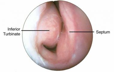 inferior turbinate septum - Septoplasty