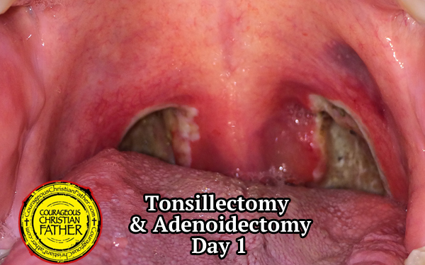 Tonsillectomy Recovery & Adenoidectomy Recovery - Day 1